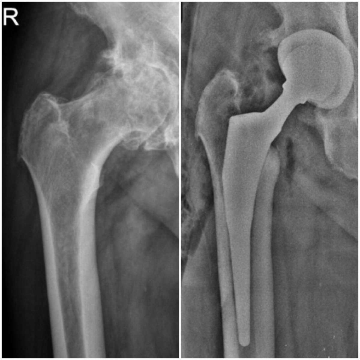 Before and after hip replacement results at Dr Andreas Papadopoulos Sports Medicine Clinic