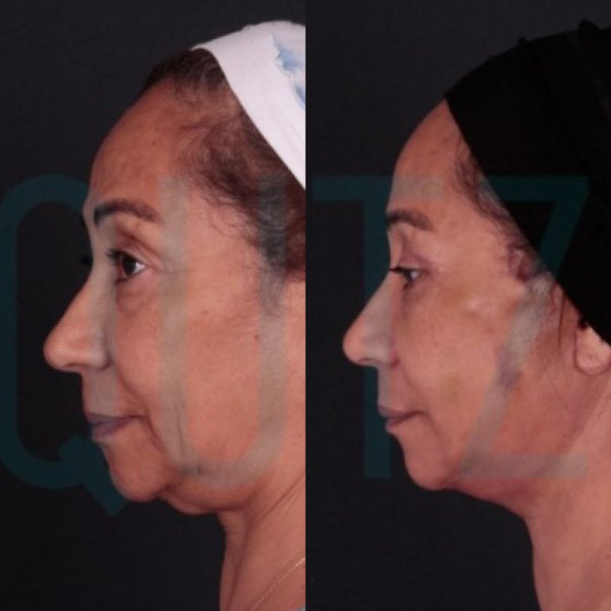 Before and after deep plane facelift results at Quartz Hospital, visible facial rejuvenation