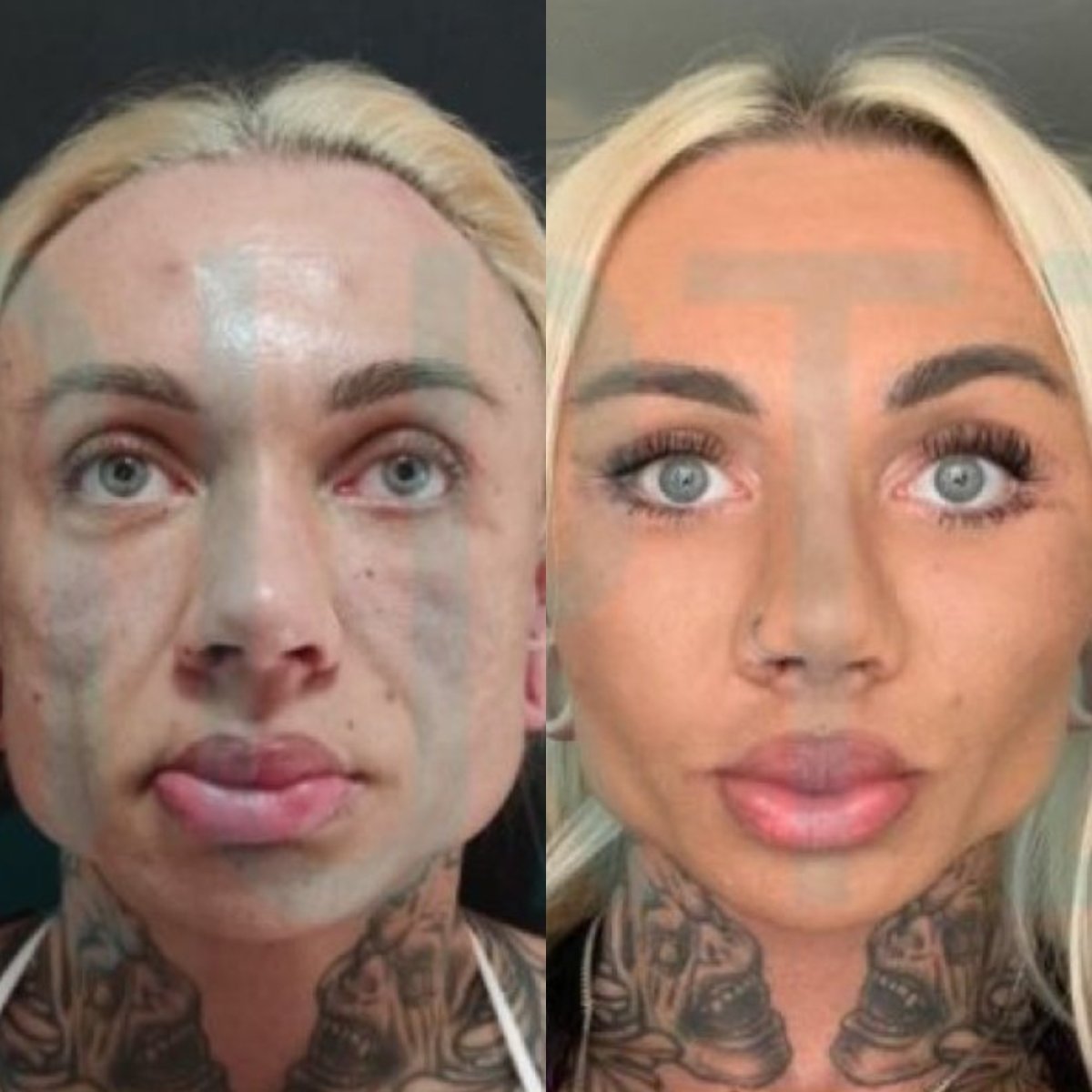 Before and after deep plane facelift results at Quartz Hospital, facial rejuvenation visible