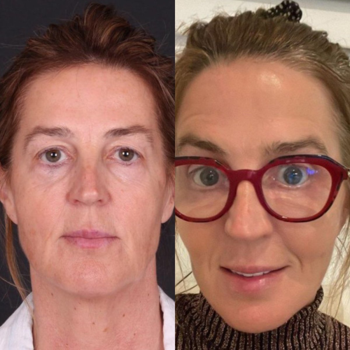Before and after Deep Plane Facelift results at Quartz Hospital – visible facial rejuvenation