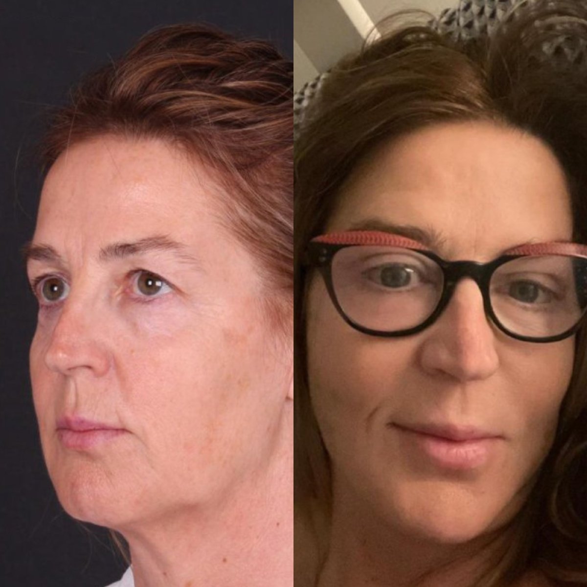 Before and after deep plane facelift results at Quartz Hospital – visible facial rejuvenation