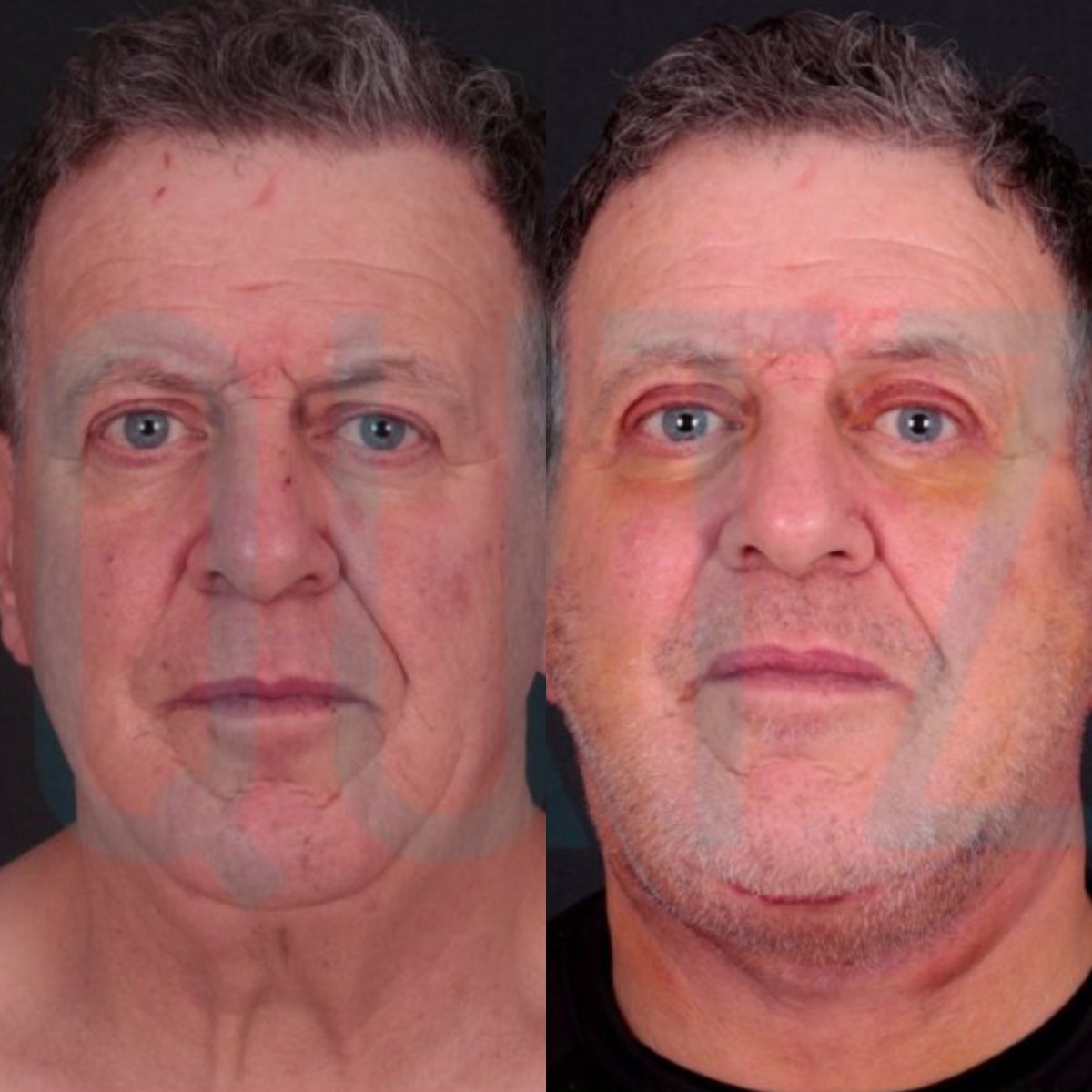 Before and after deep plane facelift results at Quartz Hospital, visible facial rejuvenation