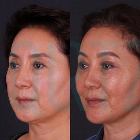 Premium Deep Plane Facelift All Included - photo 6