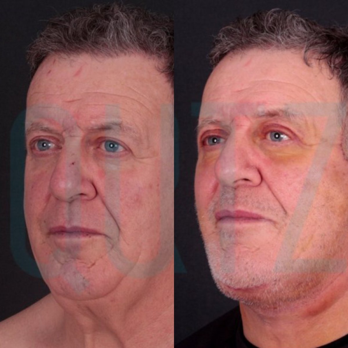 Before and after deep plane facelift results at Quartz Hospital, visible facial rejuvenation