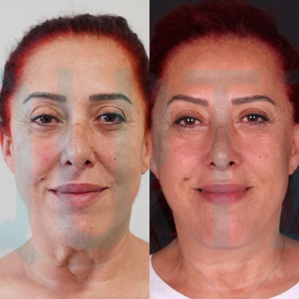 Before and after Deep Plane Facelift results at Quartz Hospital, facial rejuvenation visible