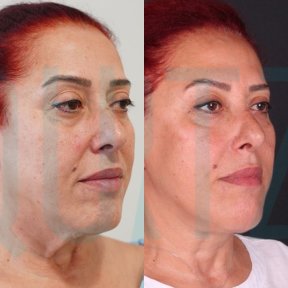 Premium Deep Plane Facelift All Included - photo 5