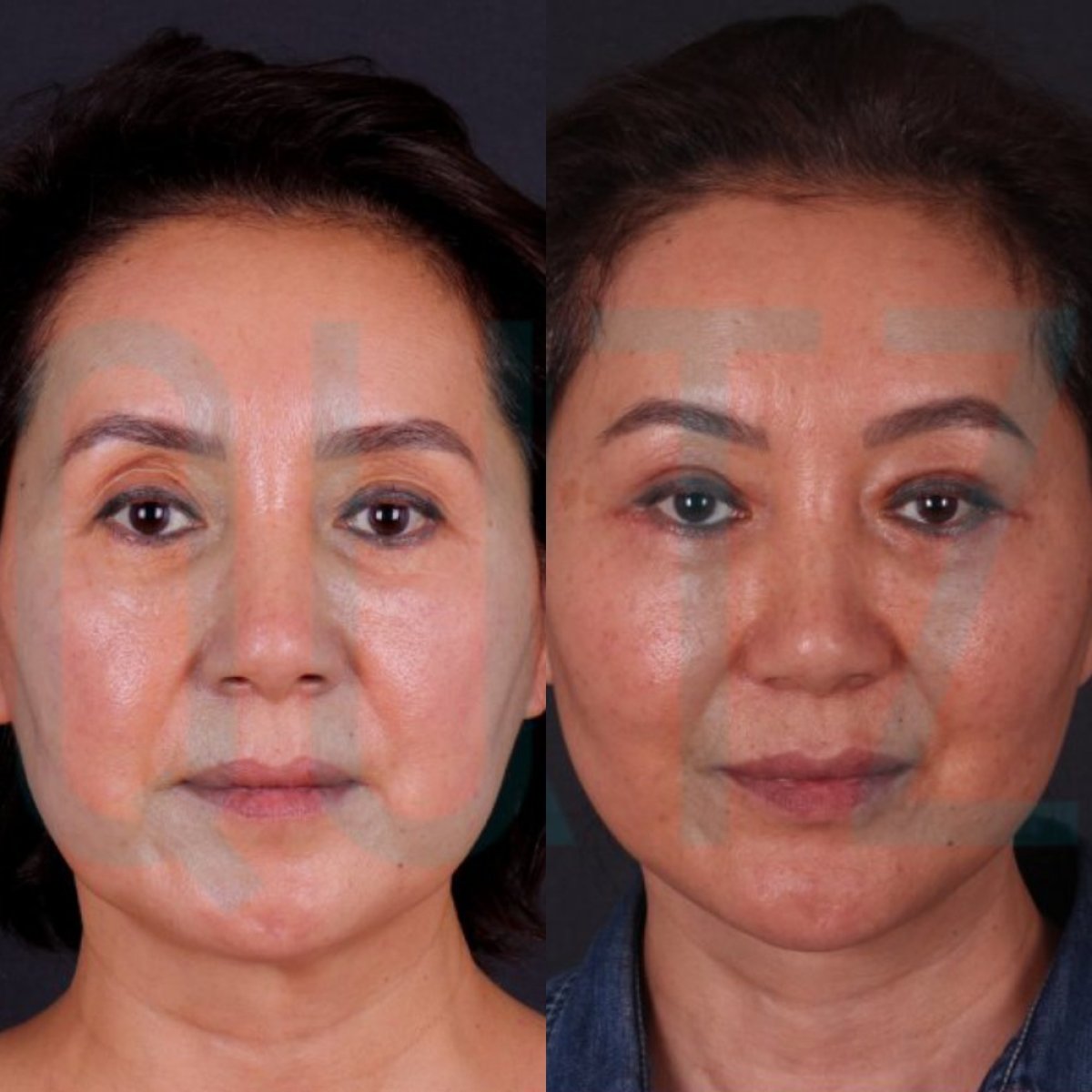 Before and after deep plane facelift results at Quartz Hospital, visible facial rejuvenation