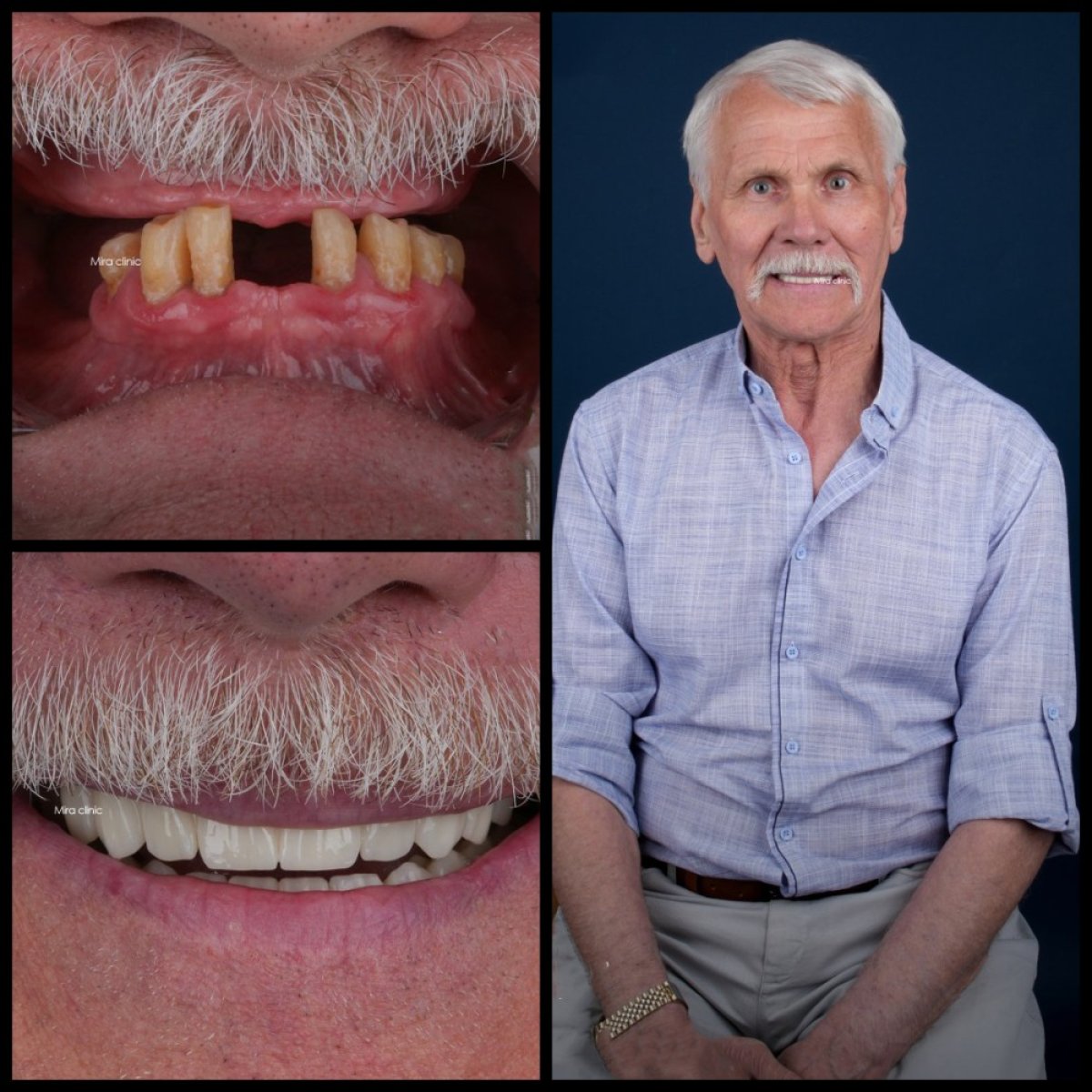 Résultat avant-après implants dentaires All-on-4 à Mira Clinic, sourire restauré