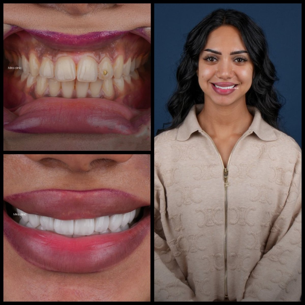 Resultados antes y después de carillas dentales en Mira Clinic, transformación visible de la sonrisa