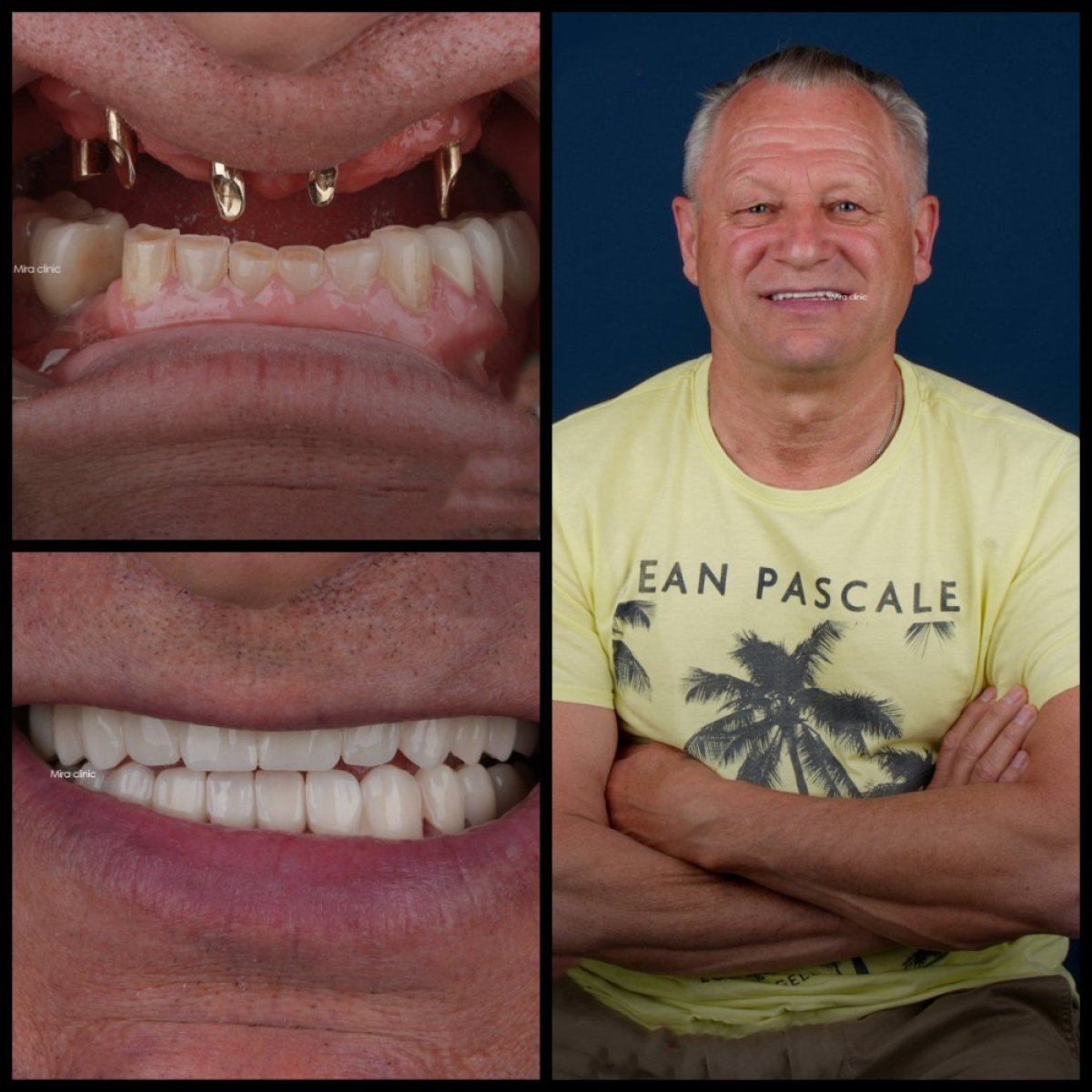 Hollywood Smile dental implants before and after results at Mira Clinic, improved smile aesthetics