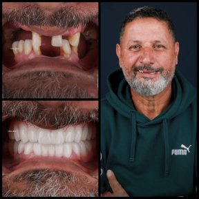 Basic All-on-6 Dental Implants - photo 5