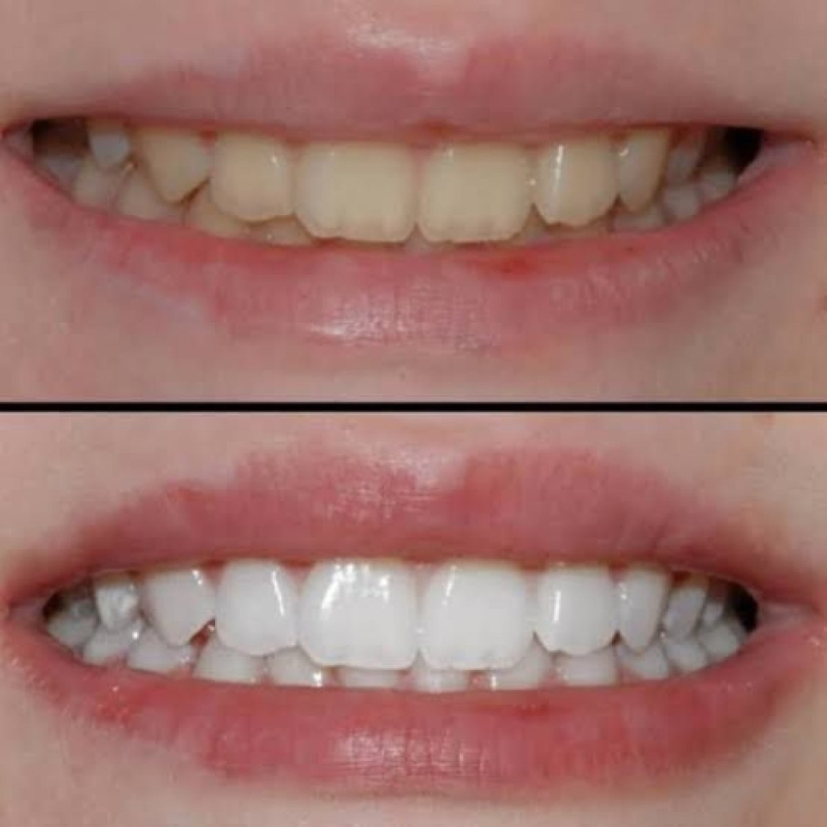 Résultats avant et après blanchiment des dents – sourire visiblement plus éclatant