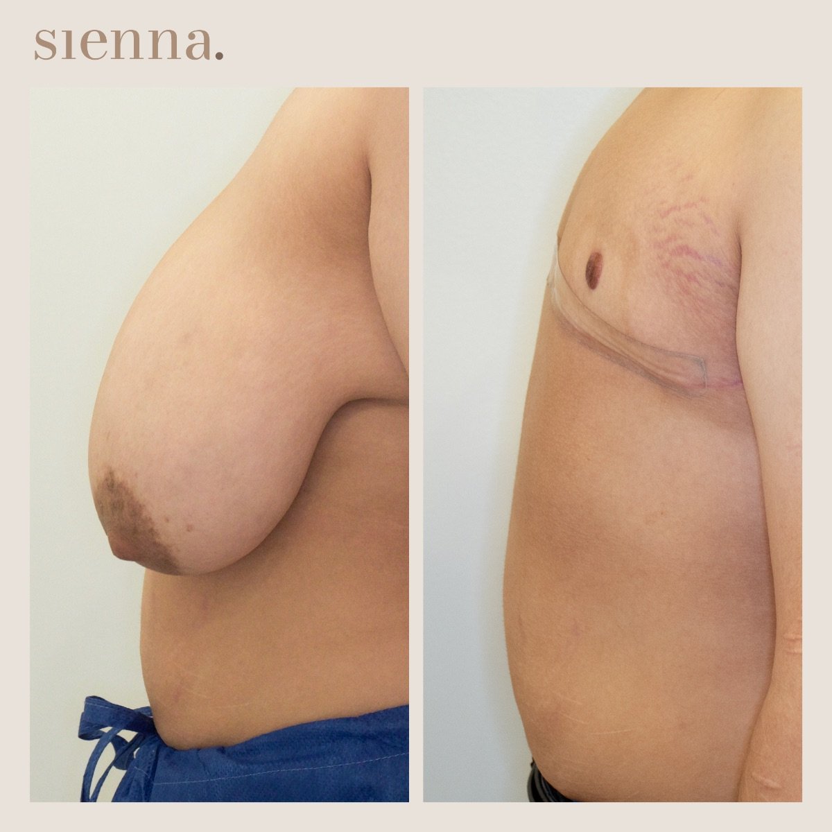 نتائج جراحة الصدر قبل وبعد في Sienna Clinic – تحول تذكير الصدر