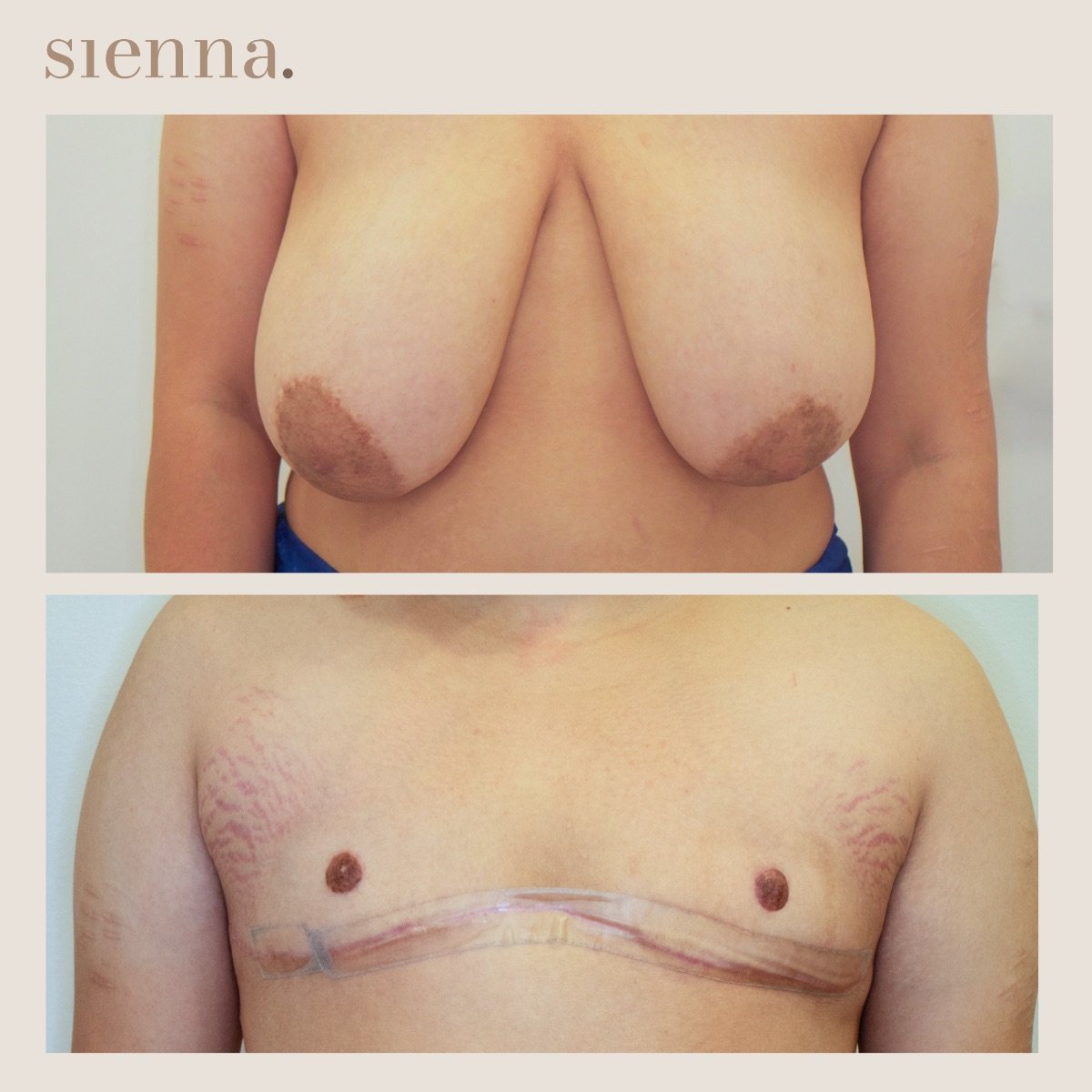 Before and after top surgery results at Sienna Clinic – chest masculinization transformation