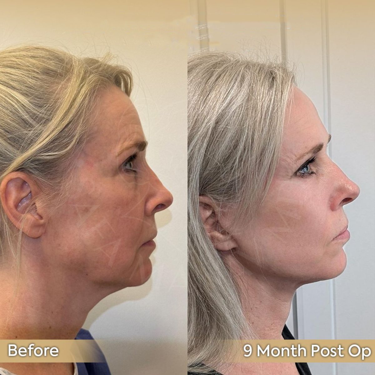 نتائج شد الوجه العميق قبل وبعد في عيادة د. صفا مناف بعد 9 أشهر من العملية