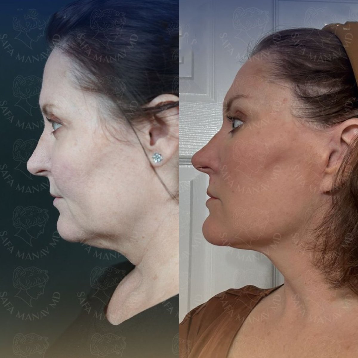 Facelift before and after results at Dr. Safa Manav Clinic, visible jawline and neck lift