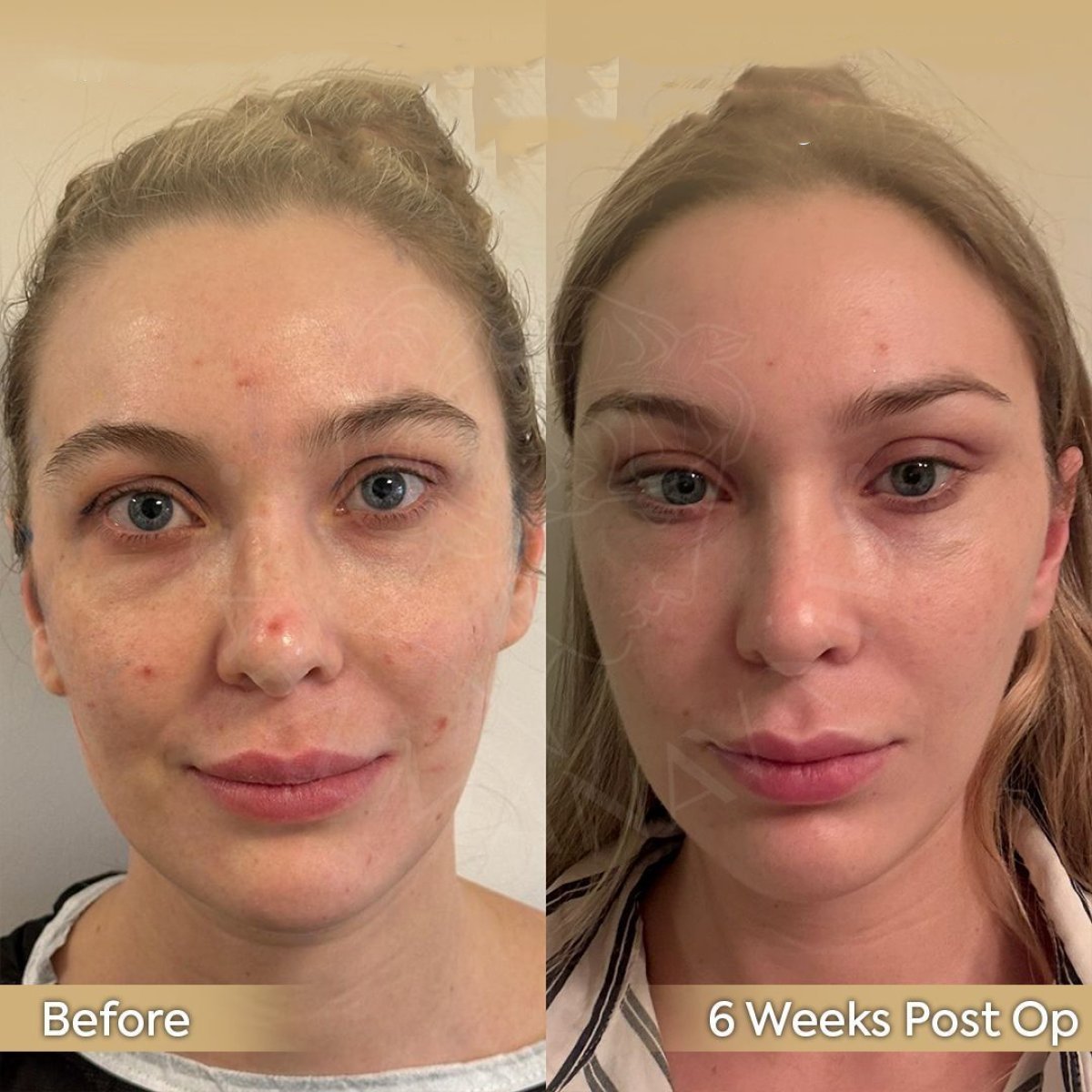 Resultados de transferencia de grasa facial antes y después en Dr. Safa Manav Clinic, 6 semanas