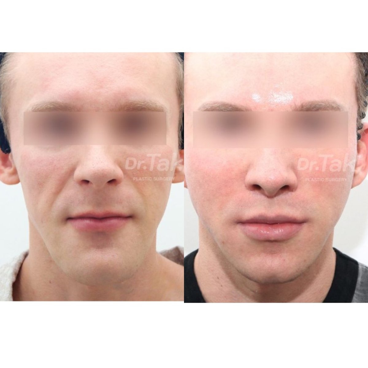 Facelift before and after results at Dr. Tak Plastic Surgery, visible facial rejuvenation