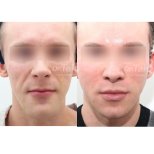 Fotos vor und nach Facelift durch Dr. Tak Seung Wan 