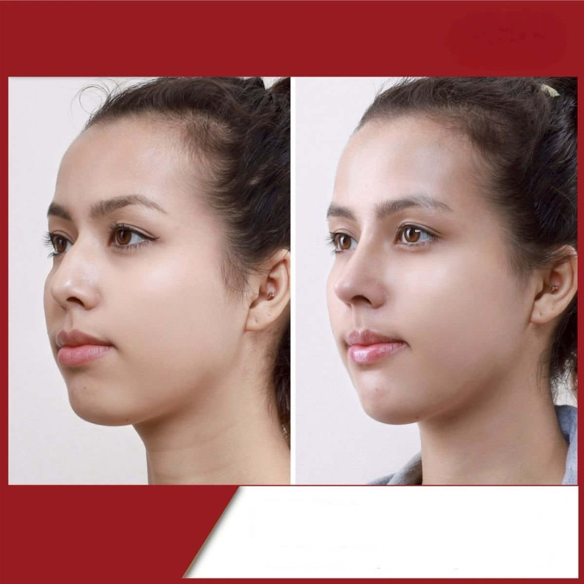 Before and after rhinoplasty results at DGB Clinic, nose reshaping with natural appearance