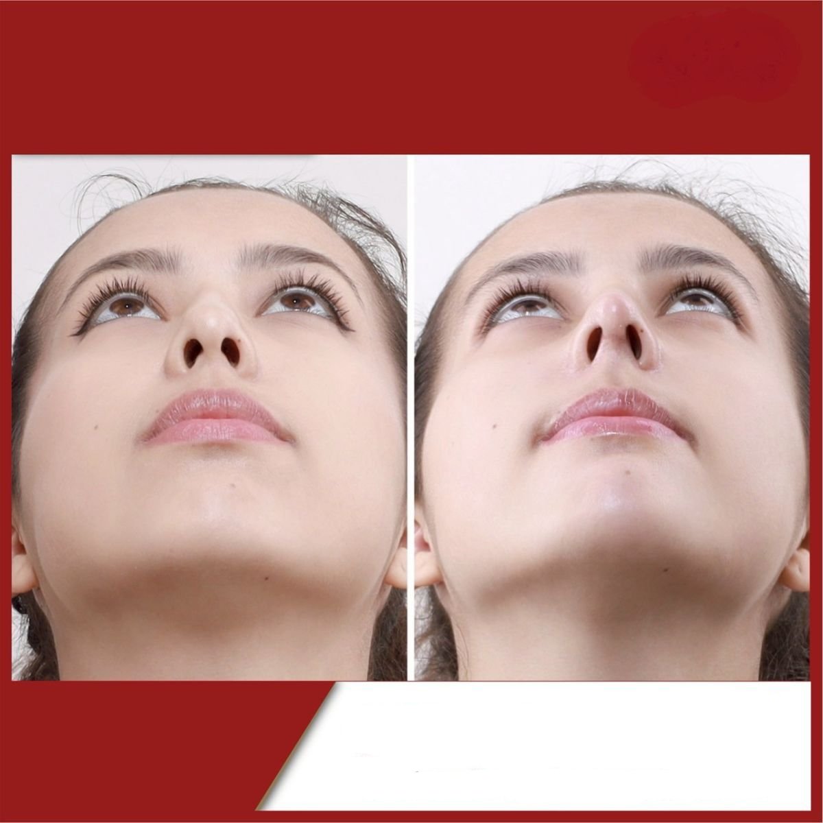 Résultats avant et après rhinoplastie à DGB Clinic, forme et symétrie du nez améliorées