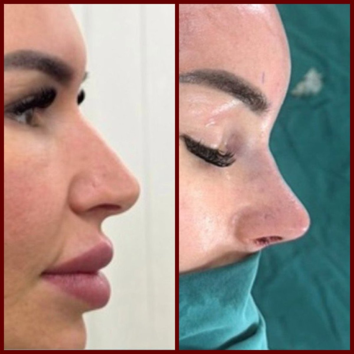 Resultados de rinoplastia antes y después en DGB Clinic, perfil nasal mejorado