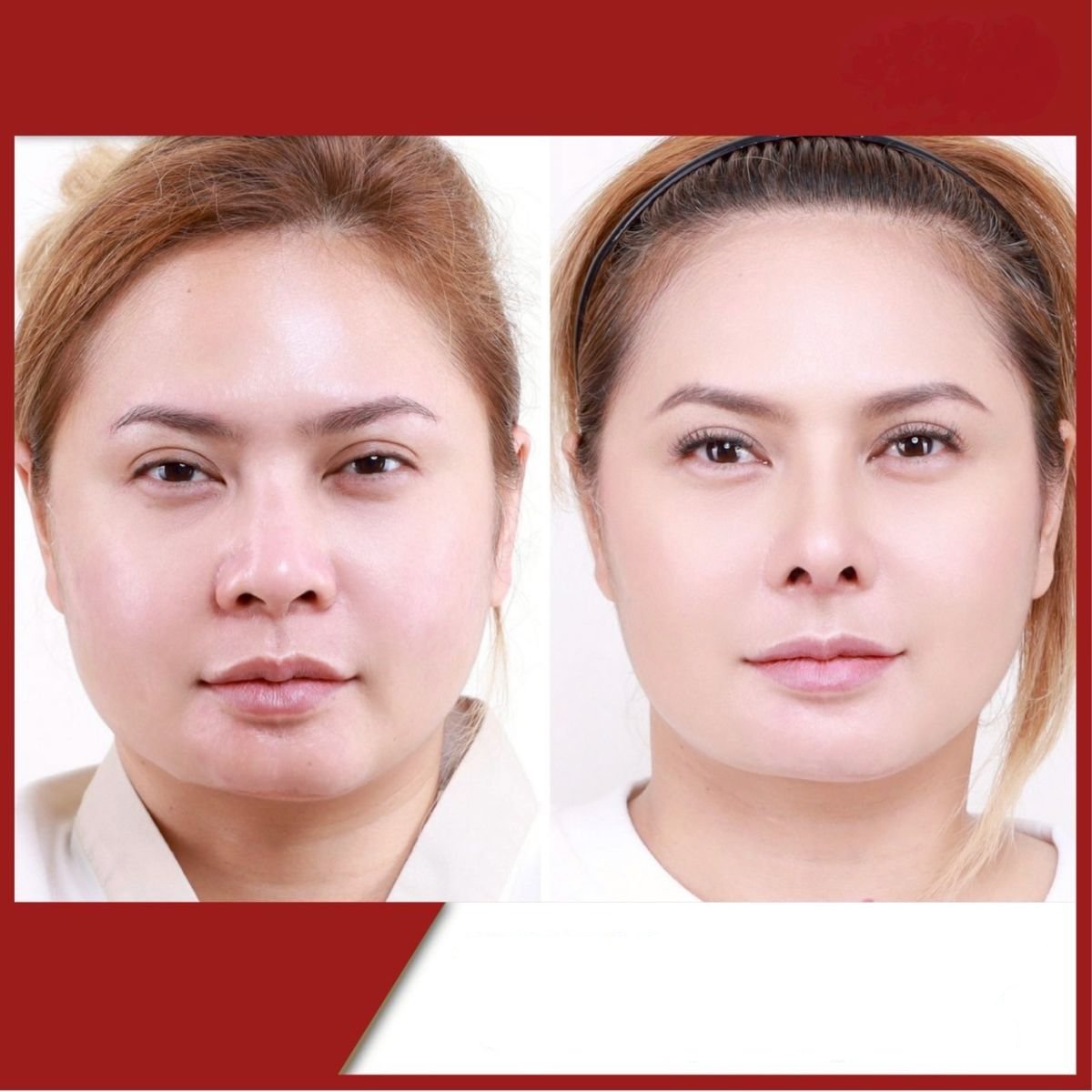 Before and after rhinoplasty results at DGB Clinic, nose reshaping with natural appearance