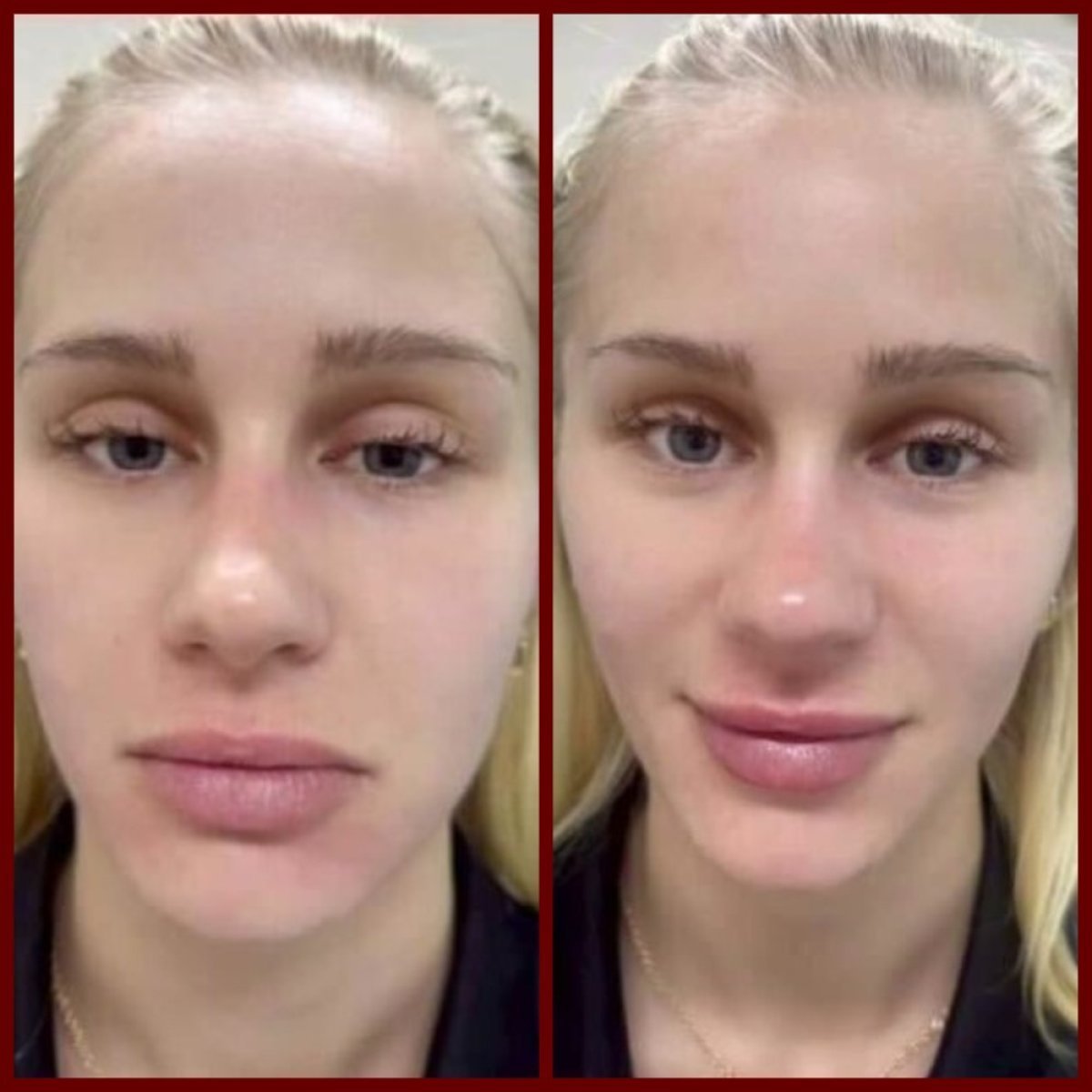 قبل وبعد علاج Ultherapy في DGB Clinic – نتائج شد ورفع بشرة الوجه