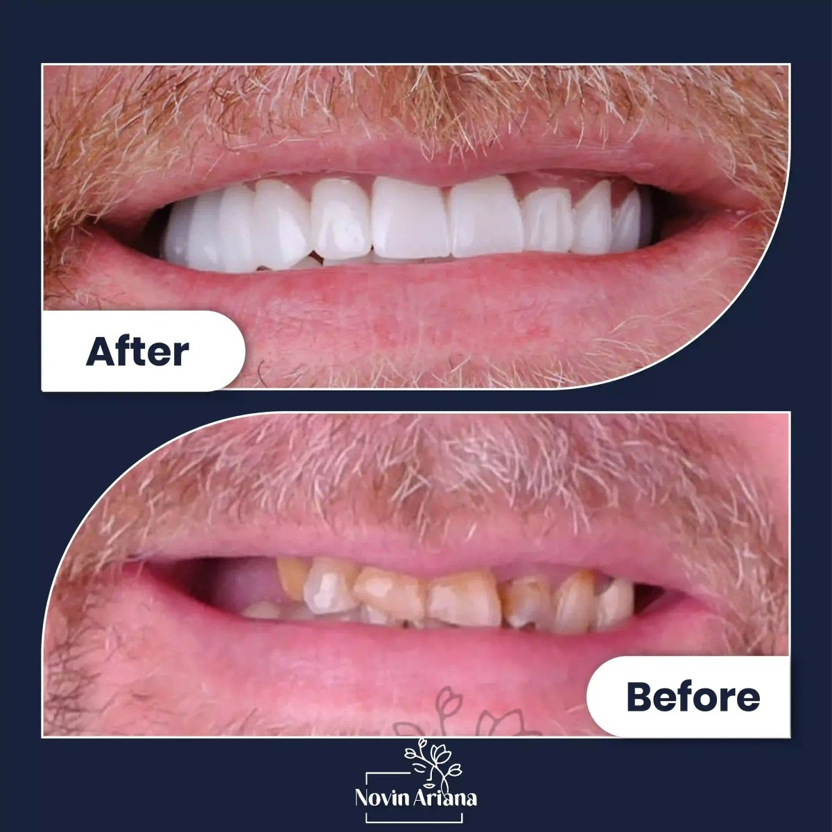 Résultats avant/après blanchiment des dents à la clinique Novin Ariana – sourire éclatant