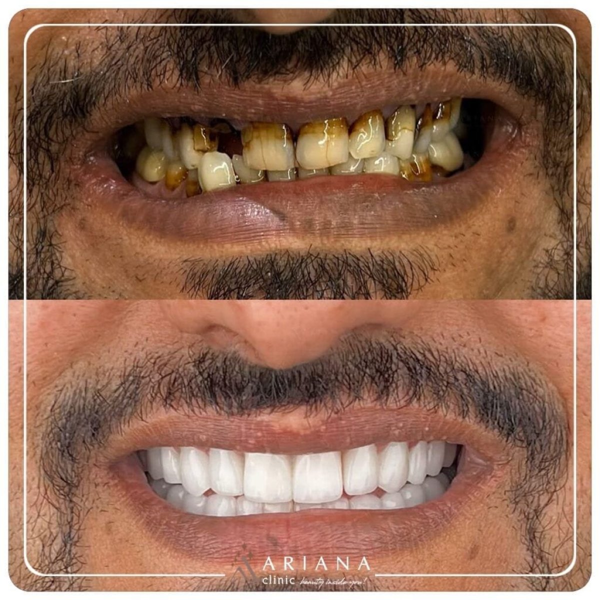 Before and after tooth whitening results at Ariana Clinic – brighter, healthier smile transformation