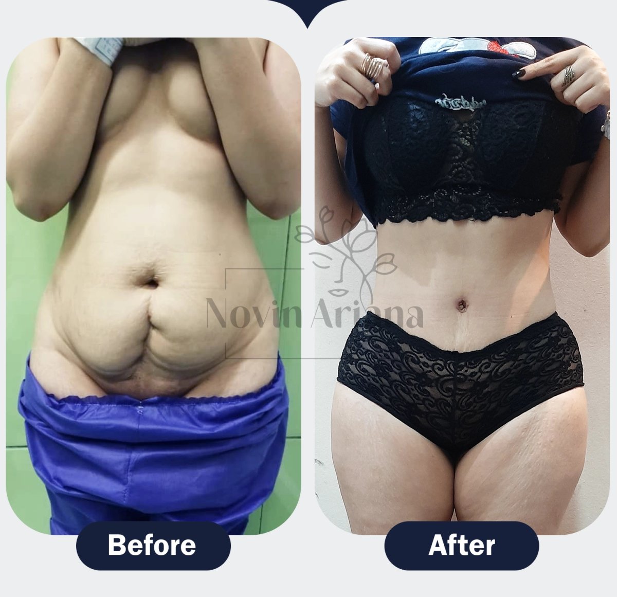 Before and after tummy tuck results at Novin Ariana Clinic – flatter, contoured abdomen