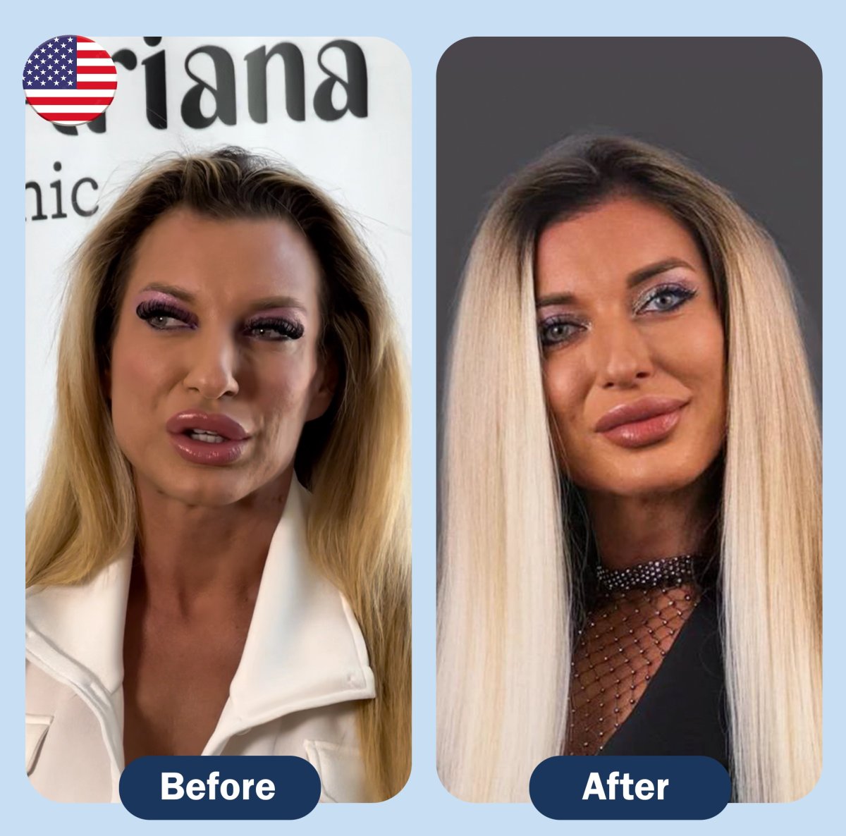 نتائج شد الوجه قبل وبعد في عيادة Ariana – تجديد شباب الوجه وتحديد الملامح