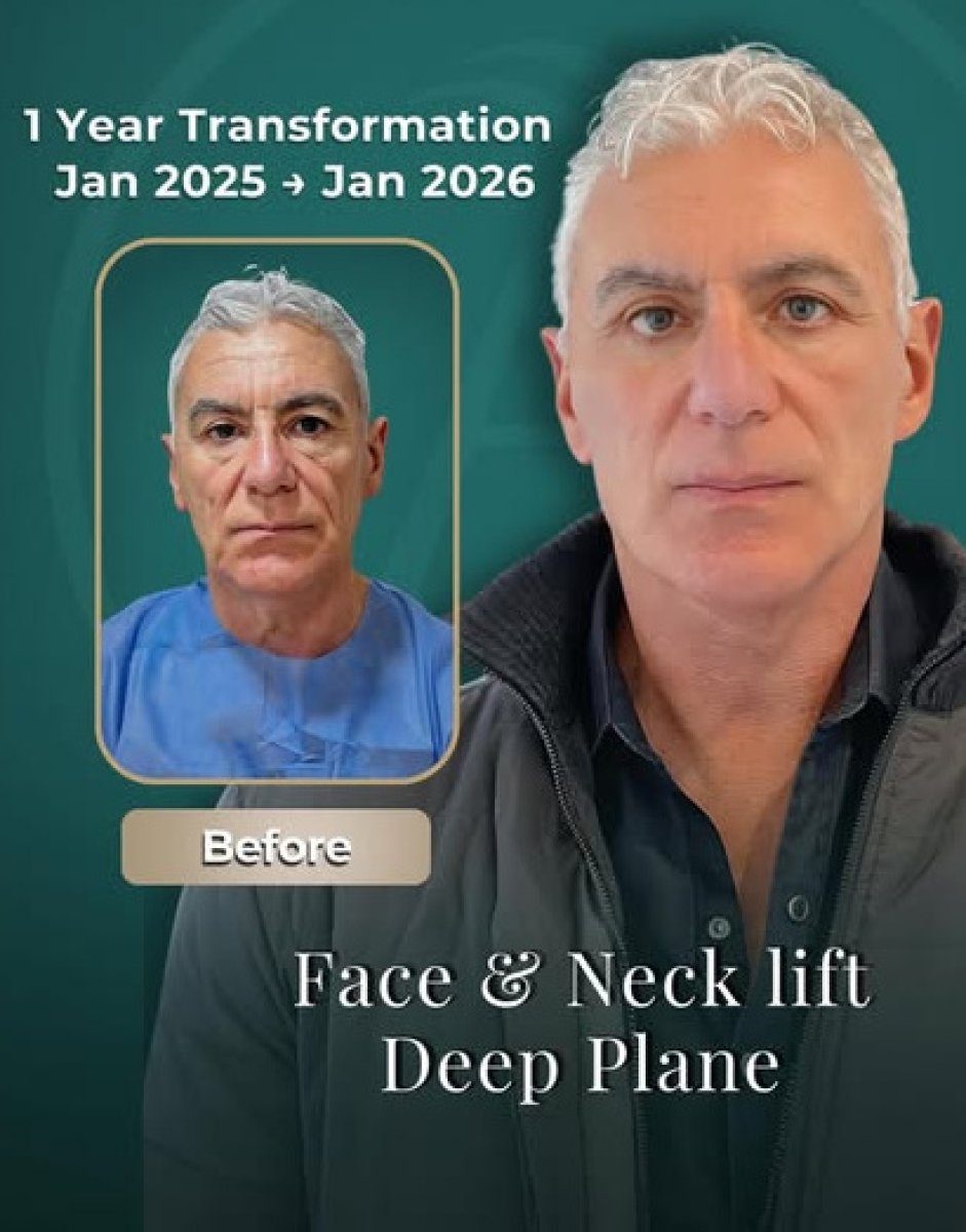 Before and after deep plane face and neck lift results – 1 year transformation visible