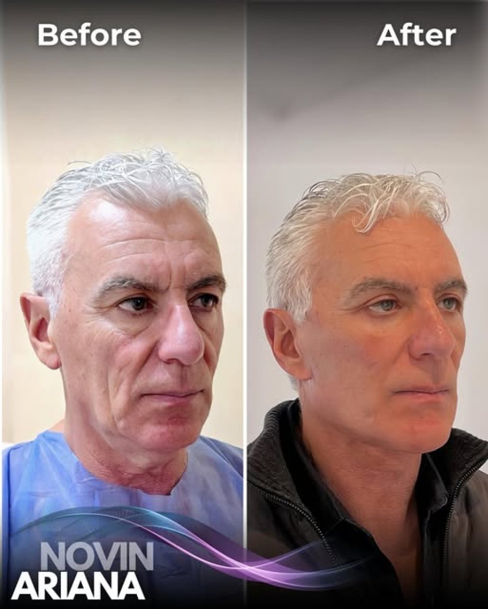 Facelift before and after results at Novin Ariana clinic – visible facial rejuvenation