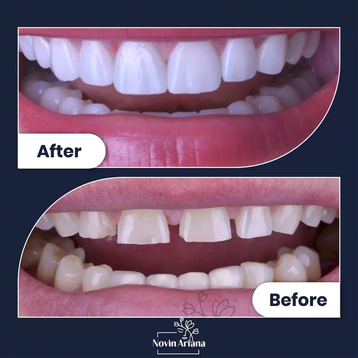 Efekty przed i po licówkach dentystycznych w Novin Ariana – metamorfoza uśmiechu