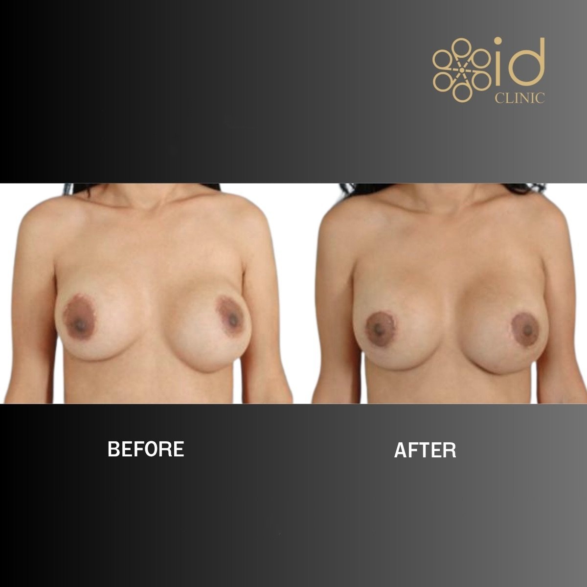Before and after breast implant revision results at ID Clinic Bangkok, improved breast symmetry