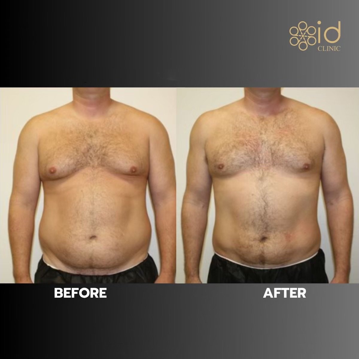 Before and after Vaser liposuction results at ID Clinic Bangkok, improved abdominal contour