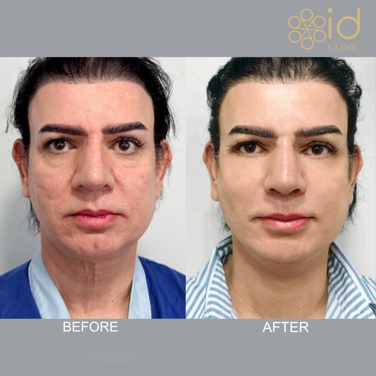 Deep plane facelift before and after results at ID Clinic Bangkok – facial rejuvenation outcome