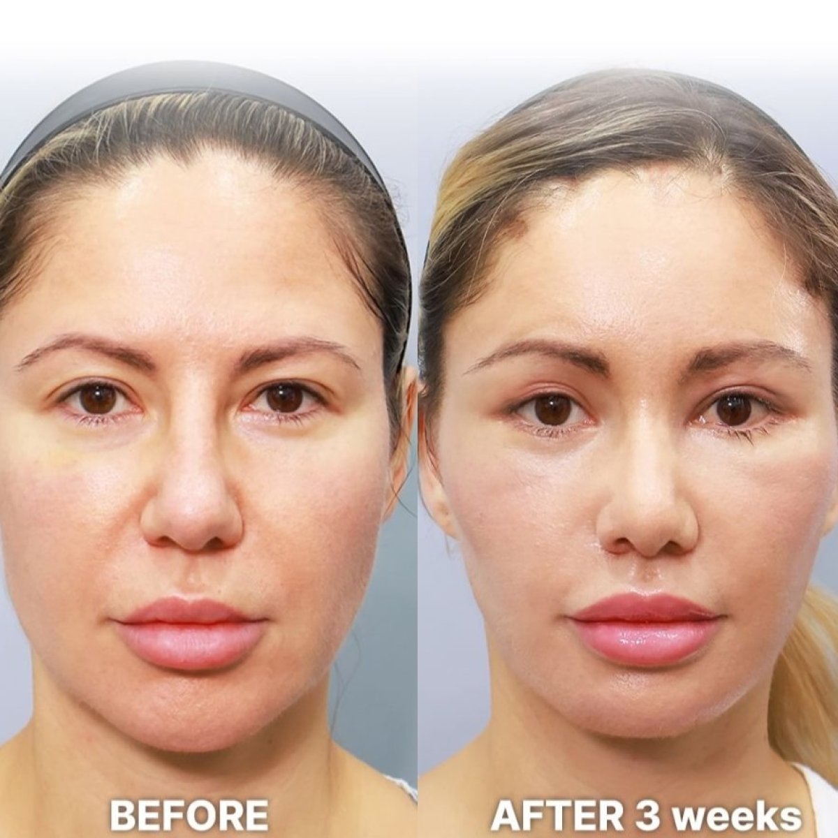 Deep Plane Facelift before and after 3 weeks result at Returning Plastic Surgery, facial rejuvenation