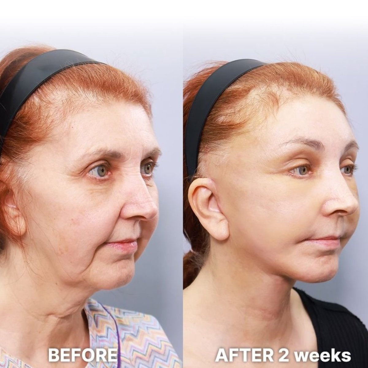 Before and after deep plane facelift results at Returning Plastic Surgery, visible facial rejuvenation