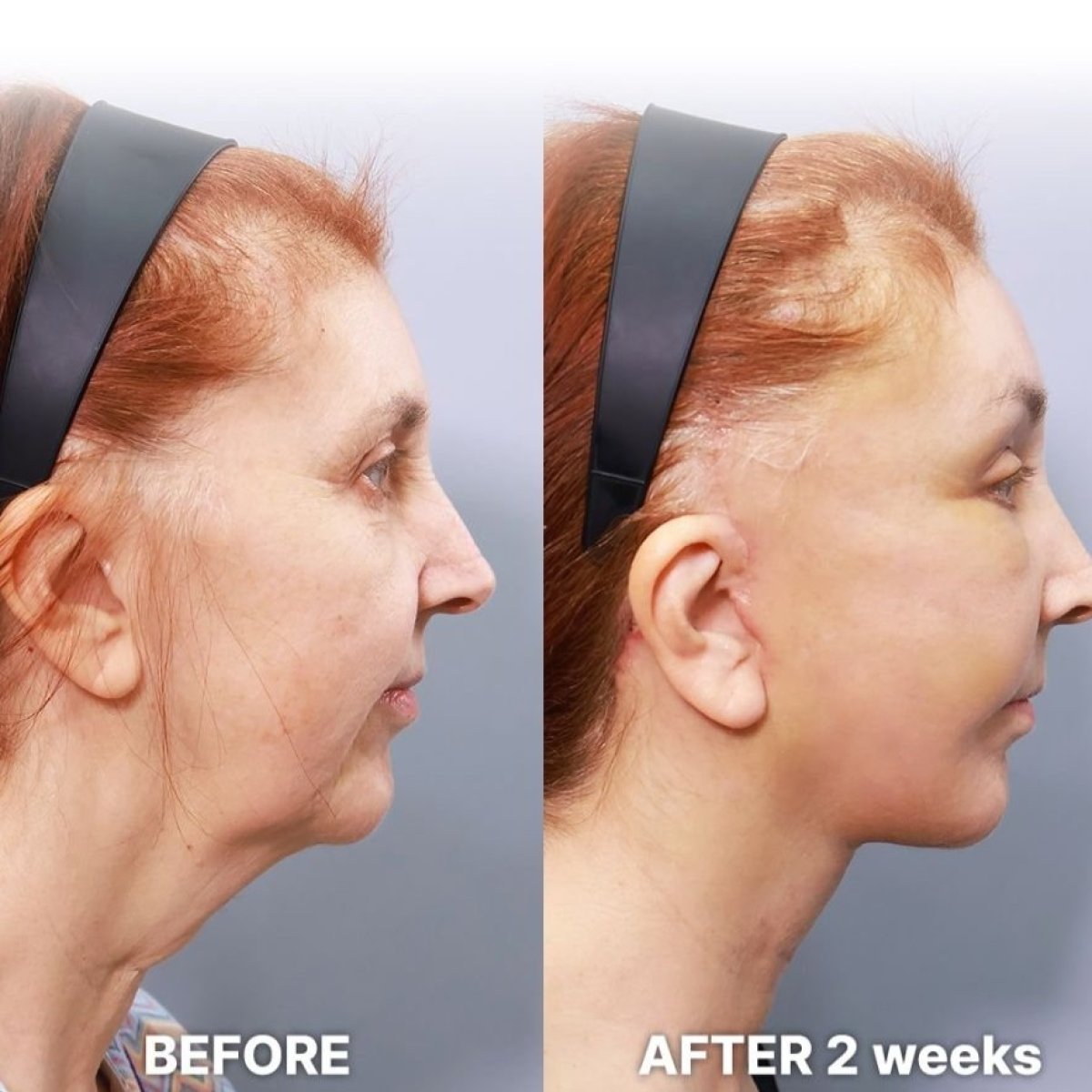Результат до та після deep plane SMAS підтяжки в Returning Plastic Surgery, чіткий овал обличчя