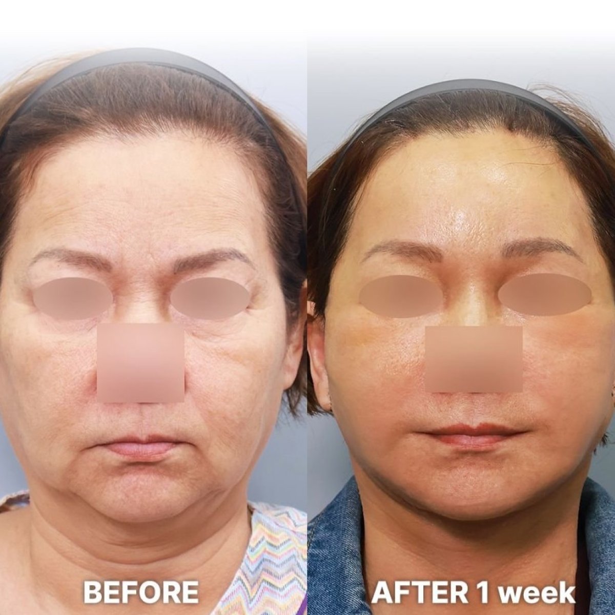 Before and after deep plane facelift result at Returning Plastic Surgery, visible facial rejuvenation