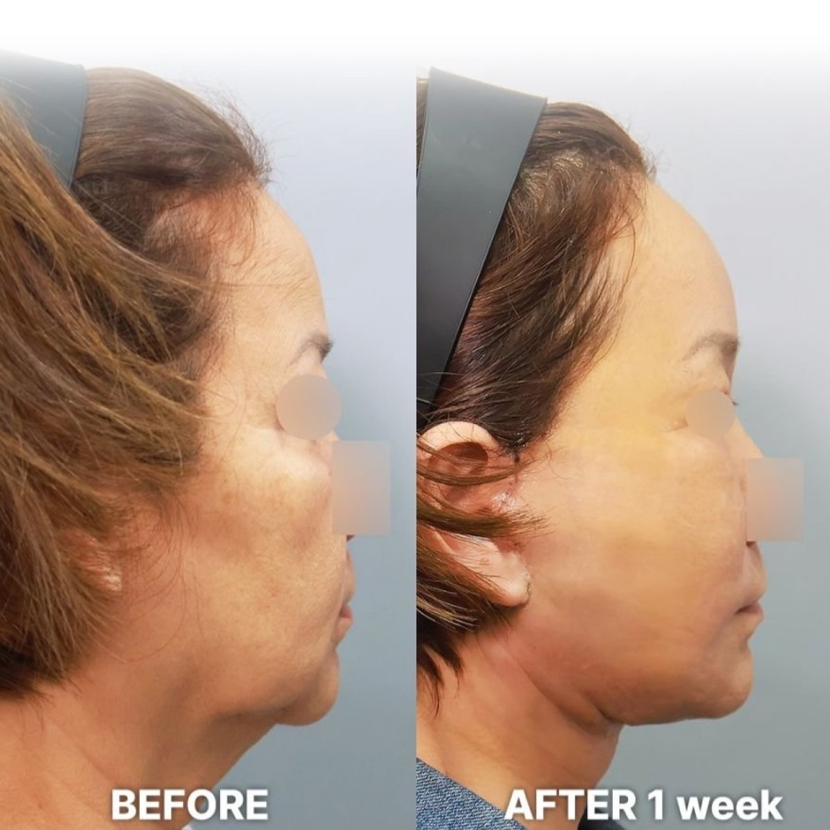 Before and after Deep Plane Facelift results at Returning Plastic Surgery, visible facial lift
