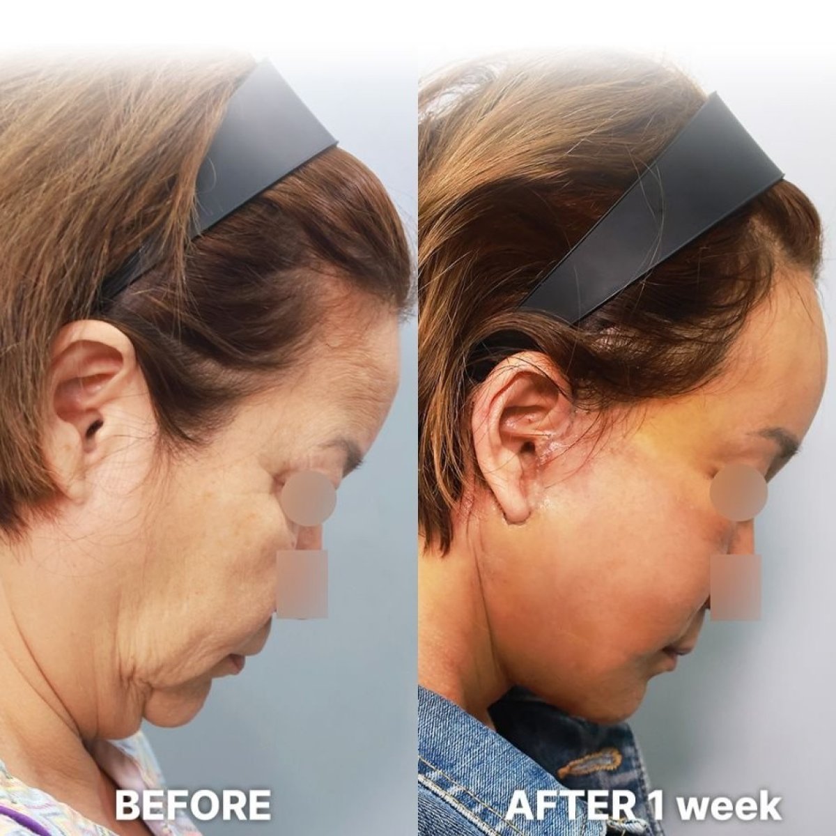 Deep Plane Facelift before and after 1 week result at Returning Plastic Surgery, visible lift effect