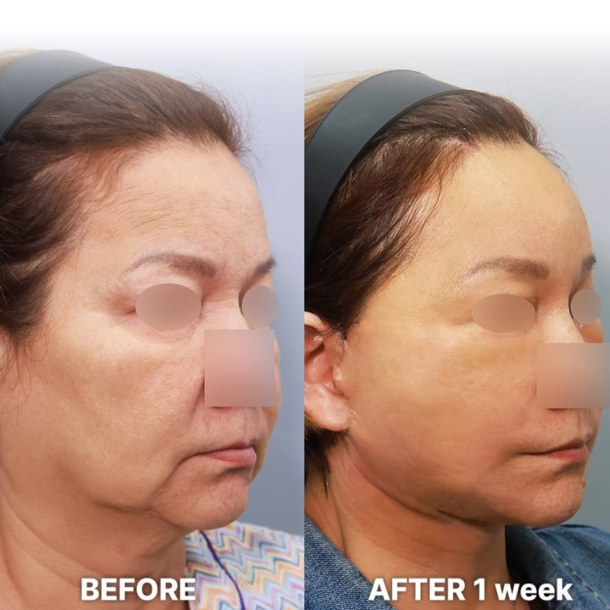 Результаты до и после deep plane SMAS лифтинга в Returning Plastic Surgery, видимый лифтинг
