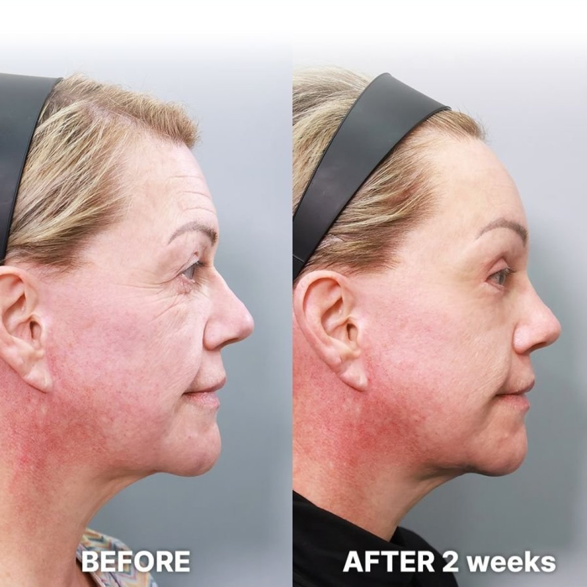 Facial fat transfer before and after results at Returning Plastic Surgery, 2 weeks post-procedure