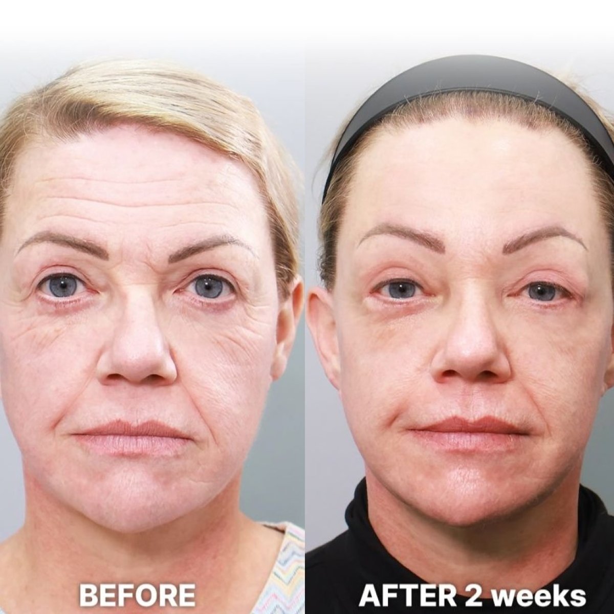 Facial fat transfer before and after results at Returning Plastic Surgery, visible rejuvenation