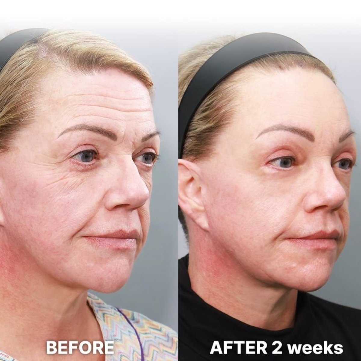 Before and after facial fat transfer at Returning Plastic Surgery, visible rejuvenation results