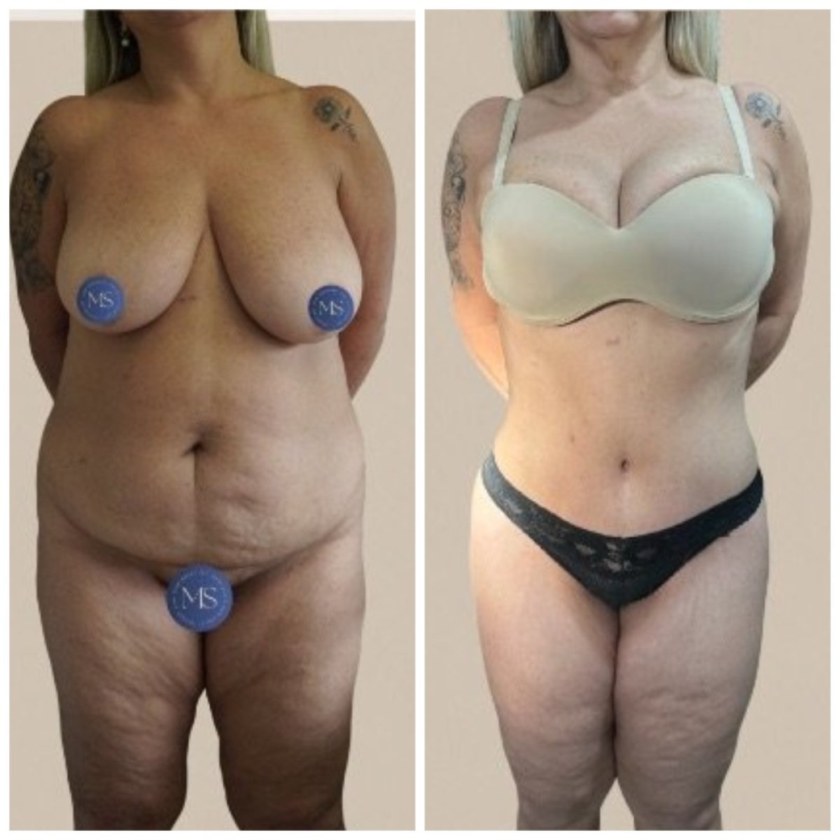 Vorher-nachher-Ergebnis der Bauchliposuktion bei Dr. Michel Salameh - Plastische Chirurgie