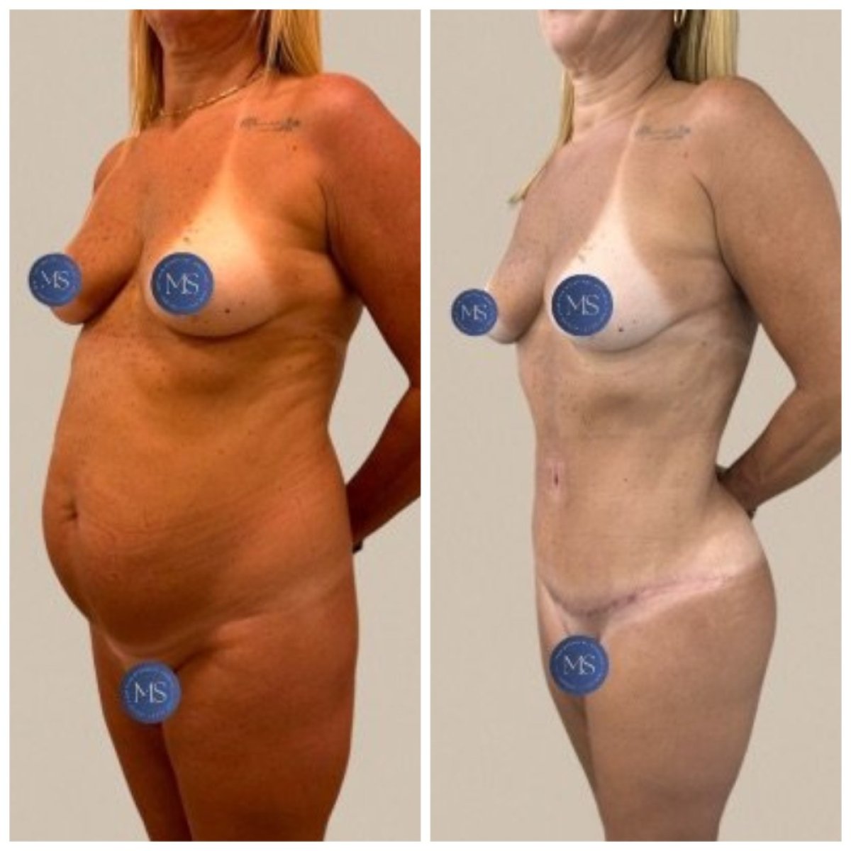 Résultats avant et après liposuccion abdominale chez Dr. Michel Salameh - Plastic And Aesthetic Surgery